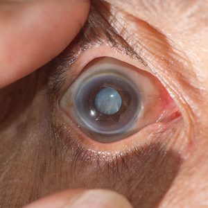 Cataract